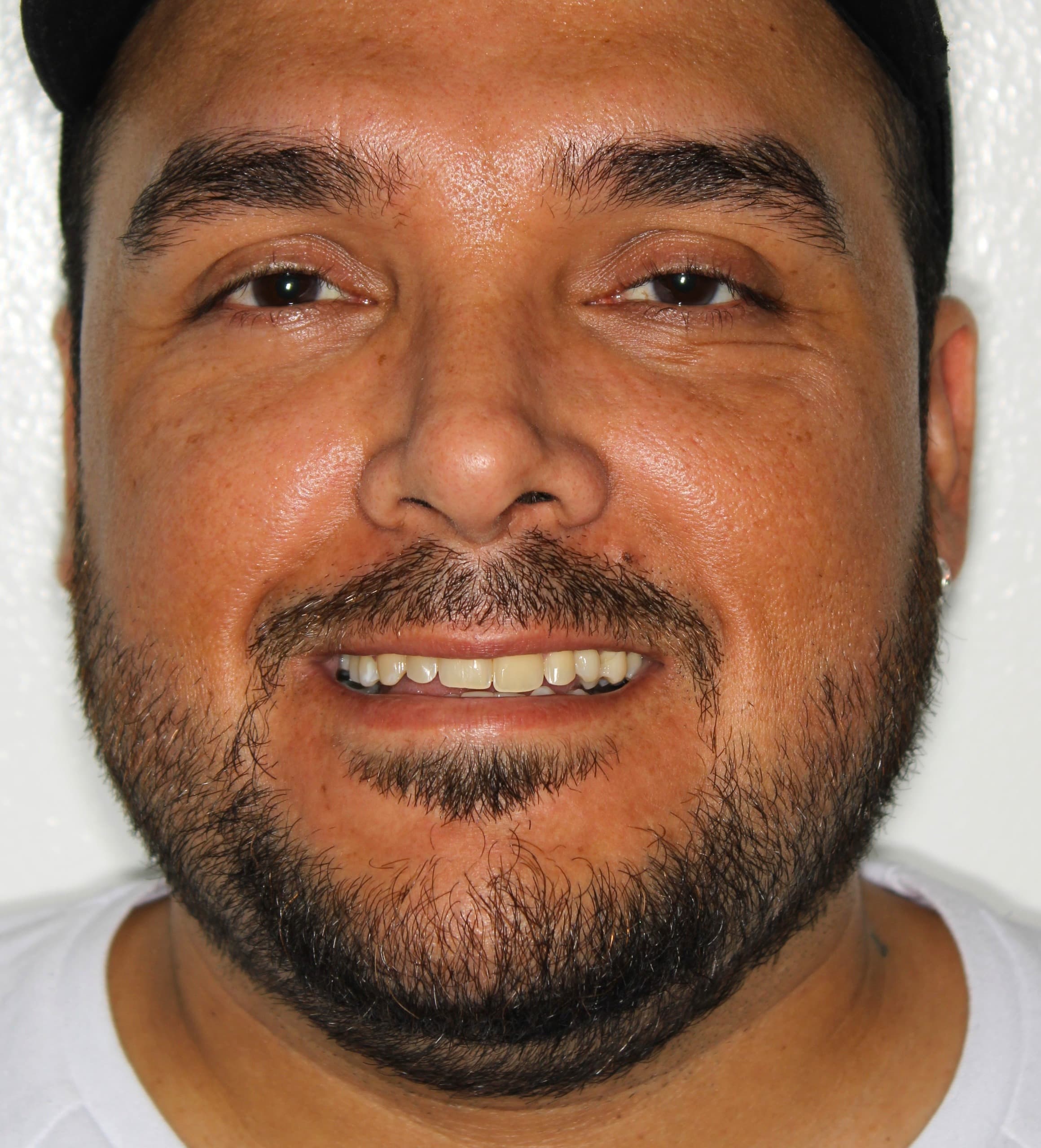 Valentín M. antes de tratamiento con brackets — caso de ortodoncia Gregory Camacho