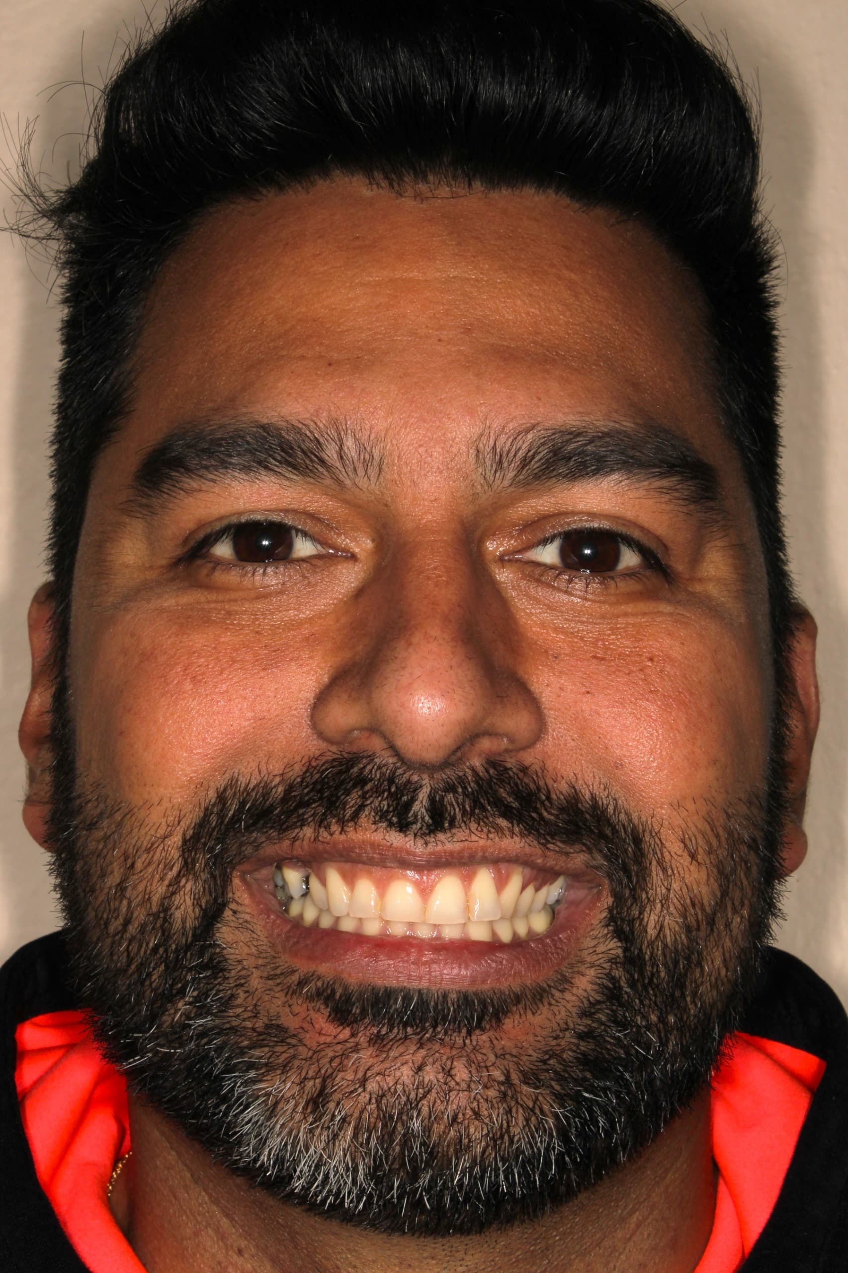 Luis C. antes de tratamiento con brackets de cerámica en Dr. Gregory Camacho