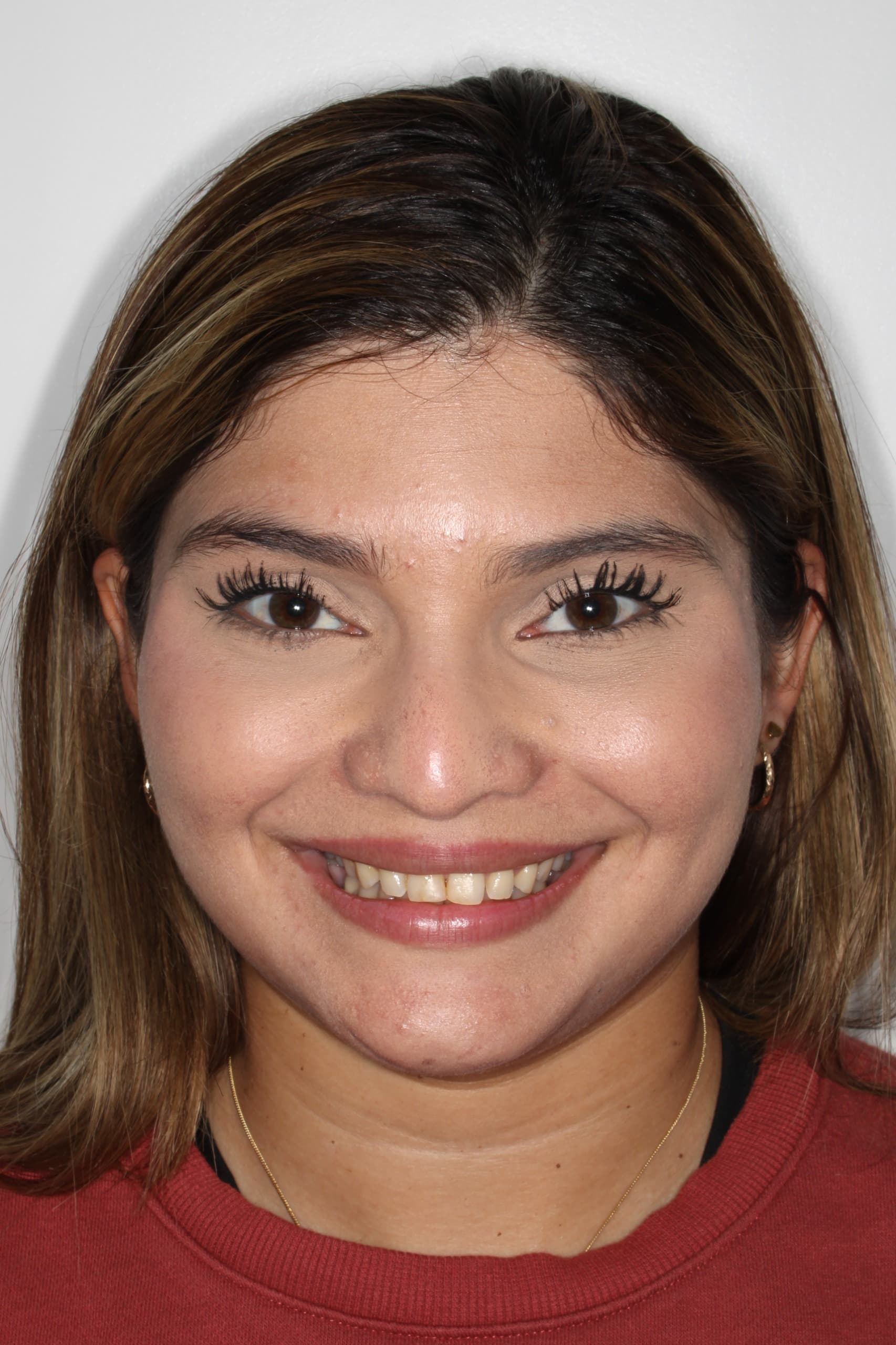 Juliana P. antes de corregir maloclusión con brackets en consultorio Bucaramanga