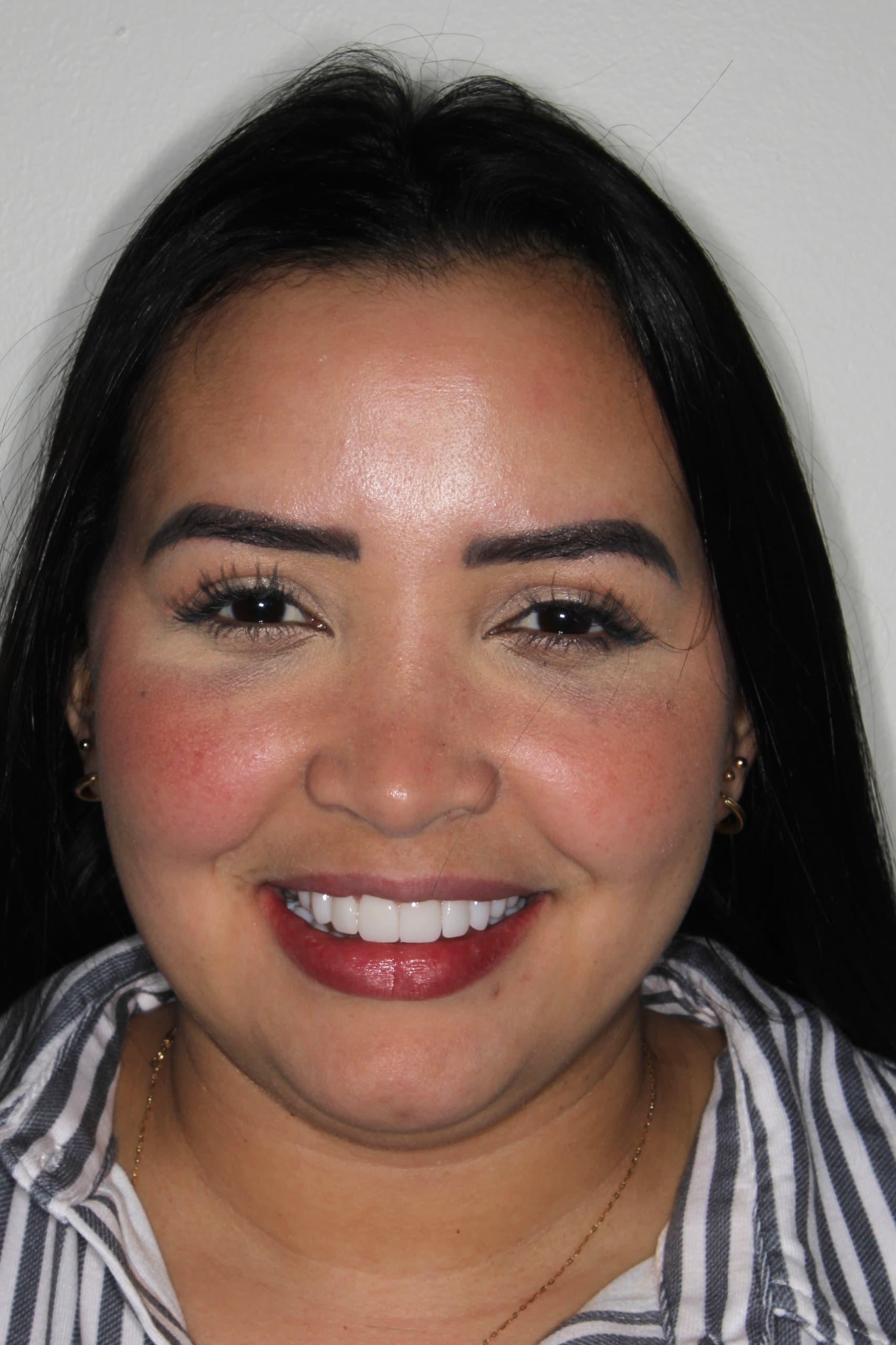 Camila V. después de tratamiento ortodóntico — alineación perfecta lograda