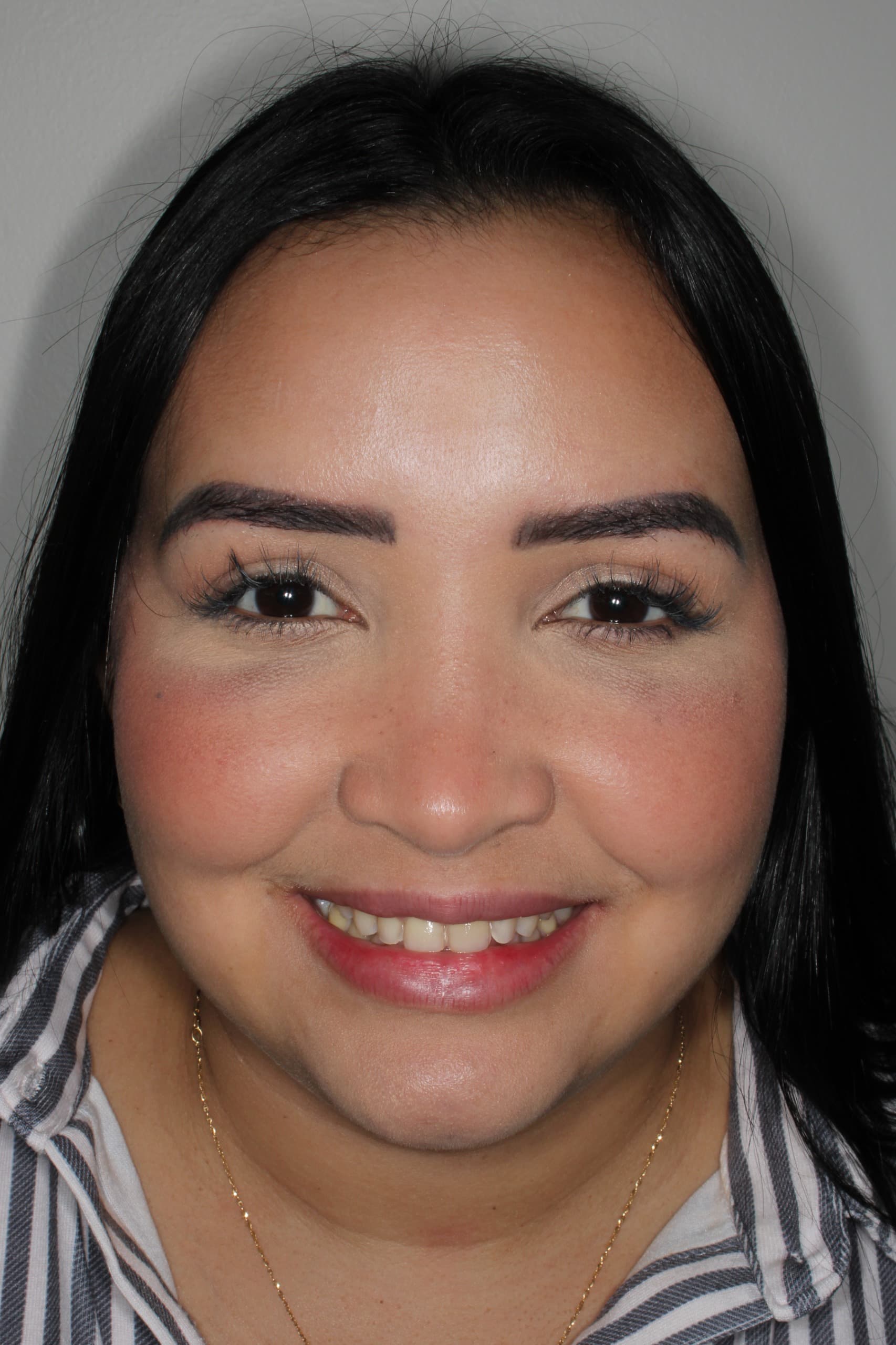 Camila V. antes de ortodoncia — apiñamiento dental inicial tratado en Bucaramanga