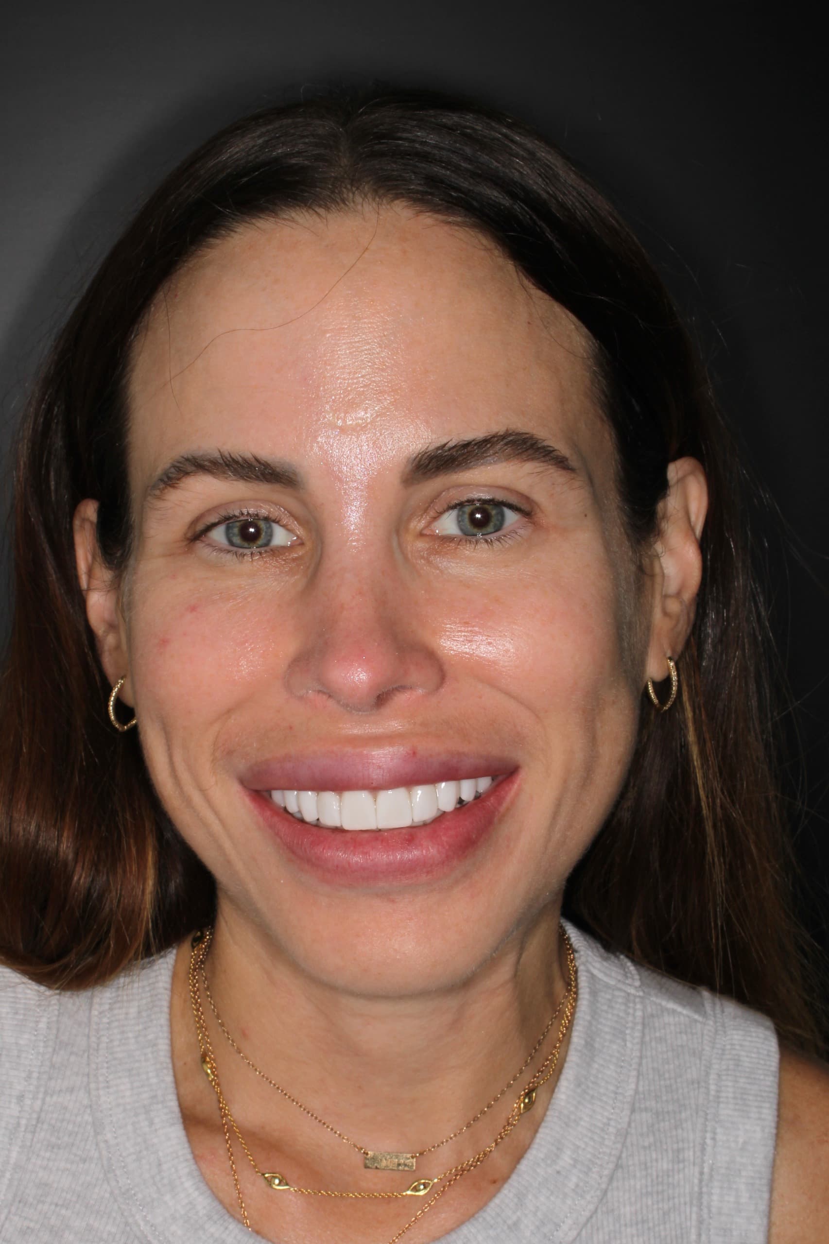 Andrea M. después de tratamiento con brackets — sonrisa perfectamente alineada