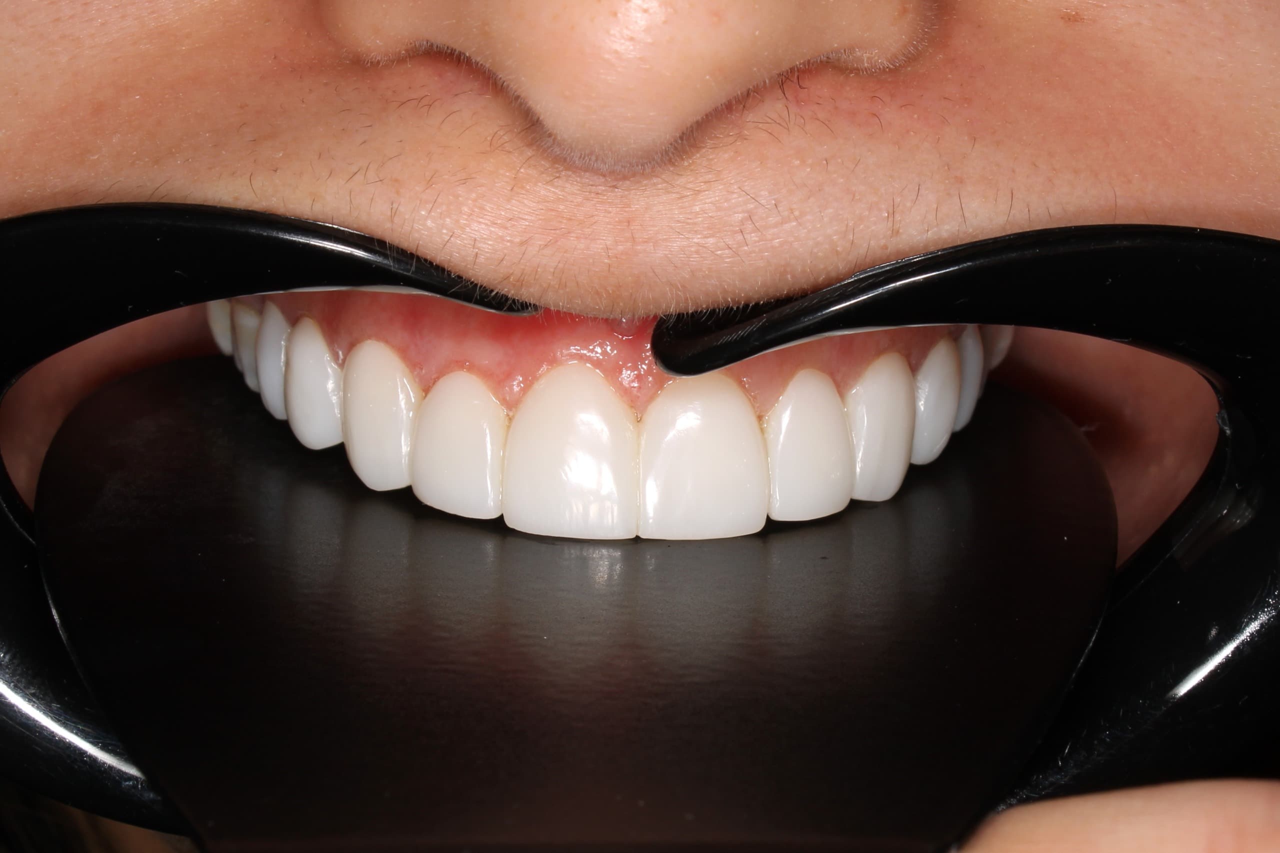 Diseño de Sonrisa